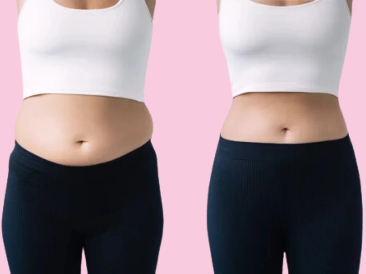 Before and after image showing belly fat reduction through liposuction in Kozhikode