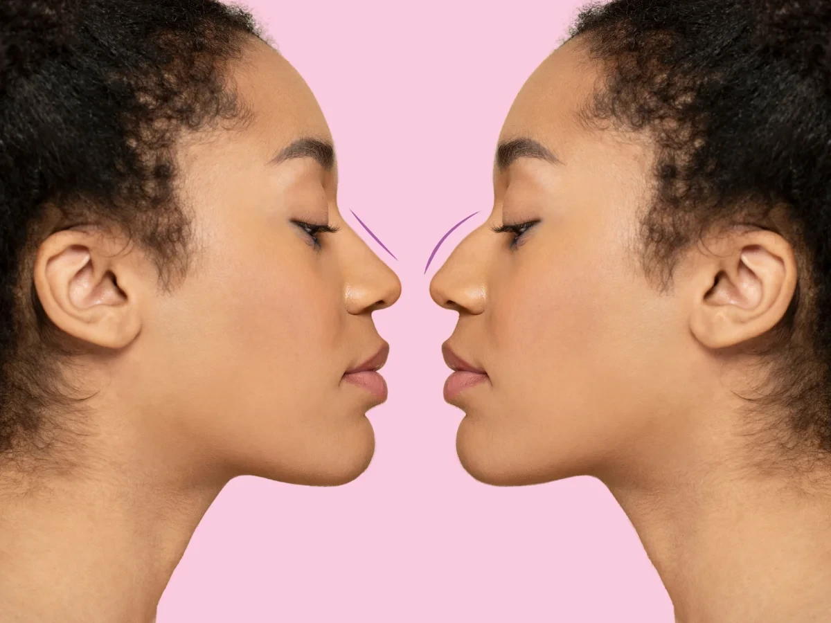 Before and after a rhinoplasty in Calicut.
