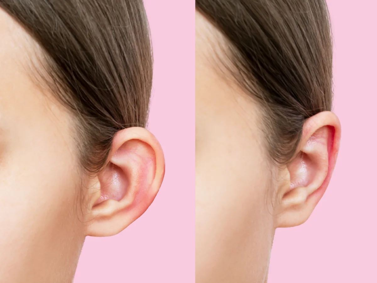 Before and after results of otoplasty in Kerala showing corrected ear shape on a woman