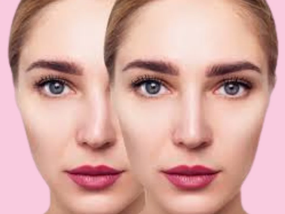Rhinoplasty in Calicut – before and after.