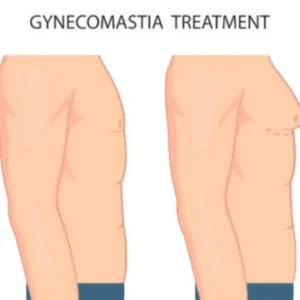 How Gynecomastia Removal Helps Restore a Masculine Chest
