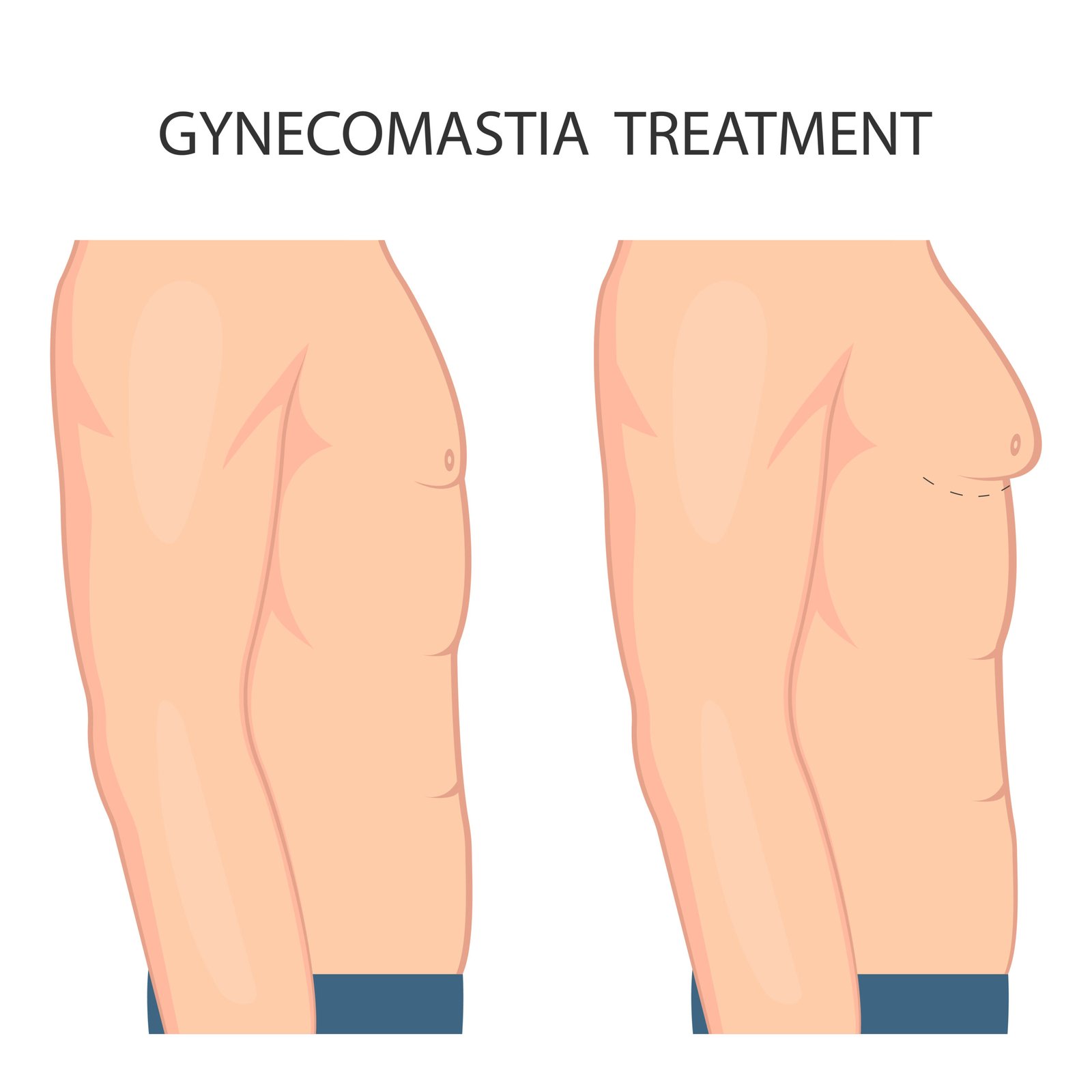 Gynecomastia Removal