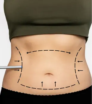 abdominal plastic surgery