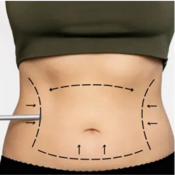 abdominoplasty